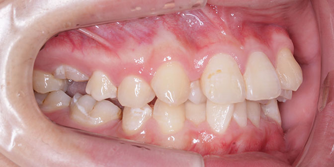 叢生（歯列の凸凹）症例 抜歯症例