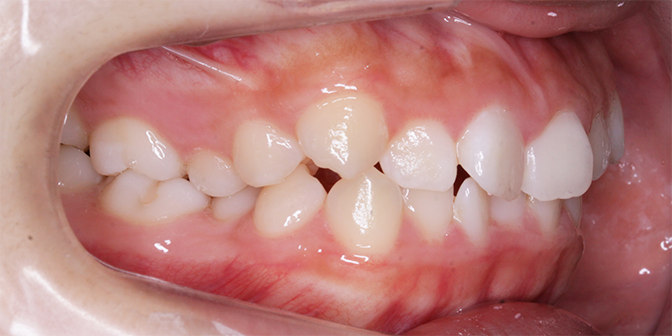 叢生（歯列の凸凹）症例 非抜歯症例