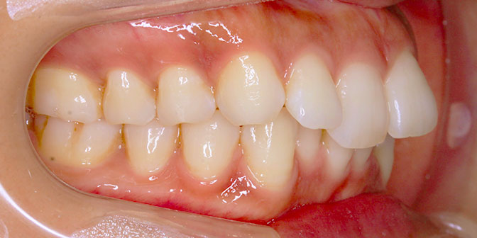 上下顎前突症例 抜歯症例