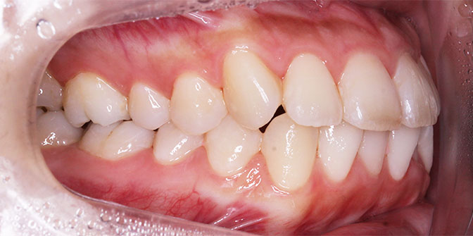上下顎前突症例 抜歯症例