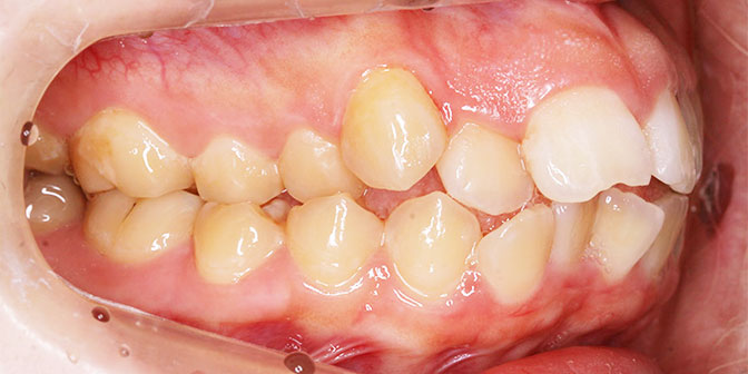 開咬症例 抜歯症例