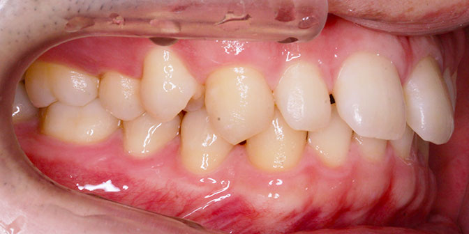 過蓋咬合症例 非抜歯症例